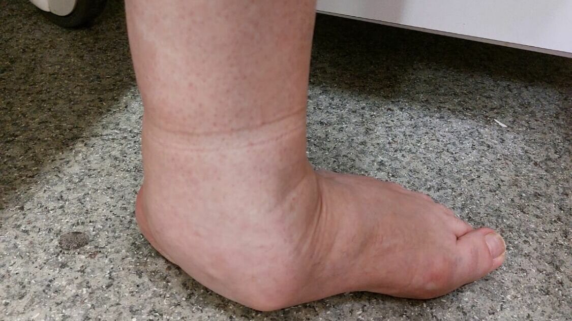 Плоскостопие в тяжелых случаях может приводить к сильным деформациям стопы, при которых трудно ходить.